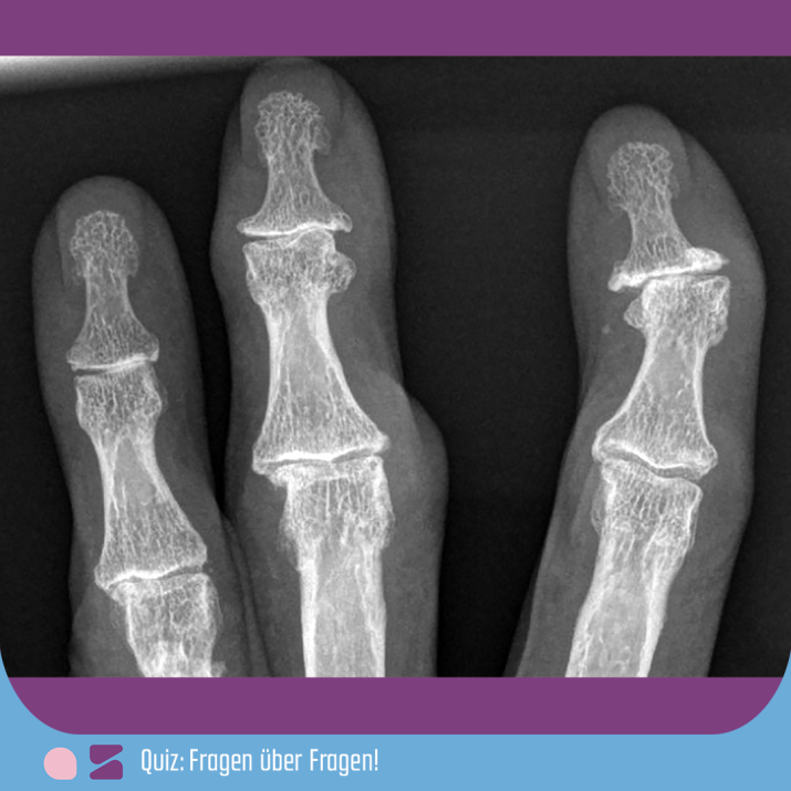 Dieses Röntgenbild zeigt typische radiographische Zeichen welcher Erkrankung?