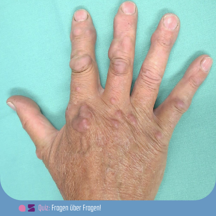 Welche Aussage zu Rheumaknoten bei rheumatoider Arthritis ist richtig? Sie...