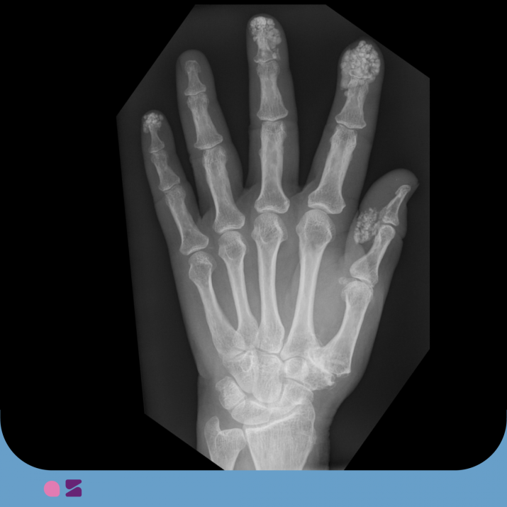 In diesem Röntgenbild findet sich eine Auffälligkeit an der Fingerendgliedern. Dabei handelt es sich am ehesten um...
